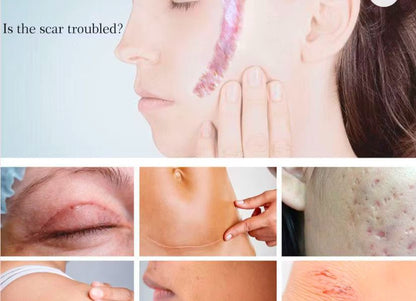 Yoxier Crème de Traitement Anti-Cicatrices